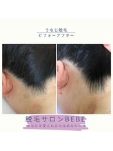 ベベ(Bebe)/うなじ脱毛♪