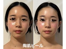 アキュセル ヨウコナース アンド 暢子美容鍼灸(Accu:Cell Youko nurse)/第5世代ピーリング　高槻/大阪