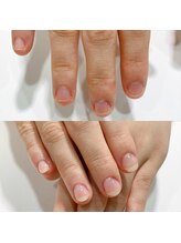 ミュゼドゥリッシュ(musee du riche)/深爪矯正