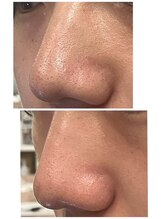 AI肌管理サロン レアリス【4月1日NEW OPEN】/ハイドラ洗浄