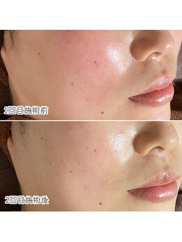 おうちサロン ミキ/赤み、敏感肌、毛穴悩みに◎