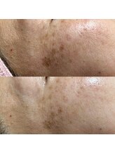 ルチルス(Rutiles)/シミ/くすみ改善/エイジングケア