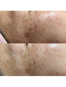 ルチルス(Rutiles)/シミ/くすみ改善/エイジングケア