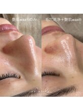 シェアリー(sharely..)/毛穴洗浄と艶肌waxで黒ずみ撃退