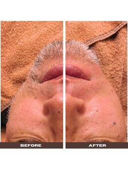 ユメバンチ(yumebanchi)/men's　W脱毛