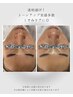 【新規限定】速攻トーンアップ！シミ・くすみ集中ケア¥11,000 &nbsp;LED照射付