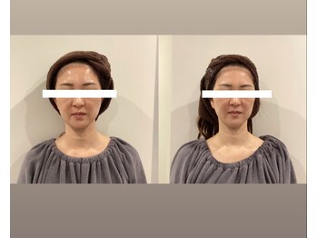 アンジェリック ビーナス(Angelic Venus)/筋膜リリース　超小顔コース♪