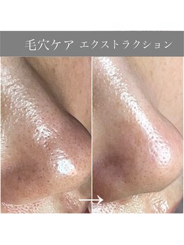 カミーシャ(KaMi-Sha)/【40代女性】毛穴症例写真