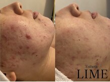 ライム 二子玉川(LIME)の雰囲気（ニキビケア/毛穴ケアの症例多数！ハーブピーリング二子玉川）