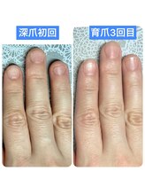 桃の木 吉祥寺店/#深爪育成 7週後