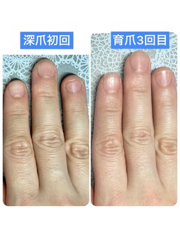 桃の木 吉祥寺店/#深爪育成 7週後