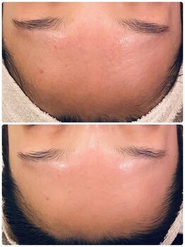 うつくし痩身 美サロン ゼットワン(Z-ONE)/カーボキシーパック