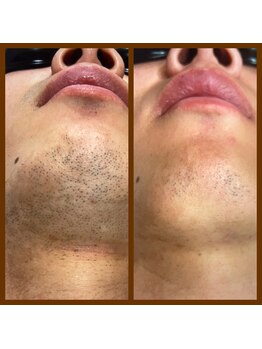 リアンジュ/ヒゲ脱毛の経過