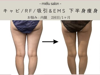 ミエル(mielu)/下半身痩身 太もも