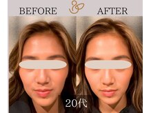 チョコバリ 新宿店(chocobari)/小顔×リフトアップ(美容鍼)20代