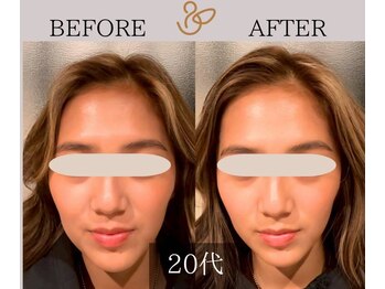 チョコバリ 新宿店(chocobari)/小顔×リフトアップ(美容鍼)20代