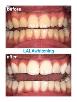 ララホワイトニング/Before&After強力ホワイトニング
