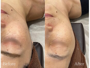 TD 鵜沼店/光フェイシャル