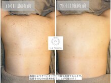 ラヴィオーラ 名駅(LaViora)/ダイヤモンドハーブピーリング