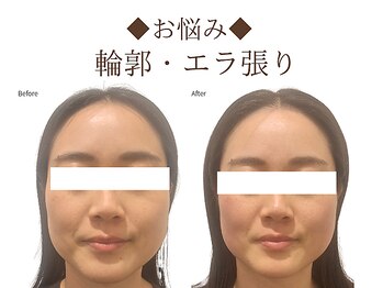 レジスタ(REGISTA)/【小顔矯正】before/after