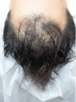 頭皮お悩み改善専門店 ウームの写真/【結果重視の方必見！】目立つ分け目・頭頂部・髪のボリューム・細毛・M字のお悩みにアプローチ！