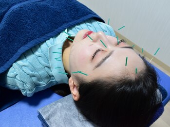 サロン ド ハリッシュ(Salon de HARISH)/美容鍼スタンダードコース★