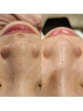 レイネイル レイエステティック 岐阜茜部店(RAY NAIL & RAY ESTHETIC)/毛穴角栓洗浄