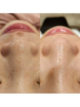レイネイル レイエステティック 岐阜茜部店(RAY NAIL & RAY ESTHETIC)/毛穴角栓洗浄