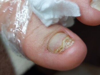 爪切り屋 足楽/爪が緑色に