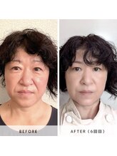 サロン レインボー(SALON RAINBOW)/小顔集中コース　Before/After