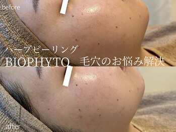 シェア(share.)/ハーブピーリング ビオフィート