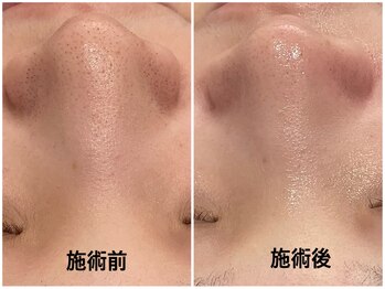 ヴィセラ(Vicella)/黒いプツプツさようなら!