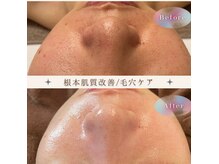 プラウディア(PROUDIA)の雰囲気（ボディハーブピーリング/背中ハーブ/ニキビケア/毛穴ケア/シミ）