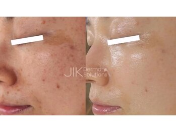 ミハン ボーテ(mihan.beaute)/【シミ・くすみ・色素沈着】