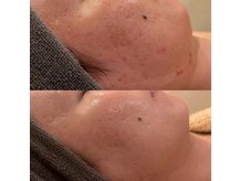 ラドンナ(LA DONNA)/ニキビ・凹凸肌改善