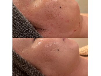 ラドンナ(LA DONNA)/ニキビ・凹凸肌改善