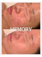 メモリー(MEMORY)/まるで別人☆陶器肌へ
