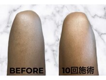 ザ サンラウンジ 長野店(THE SUN LOUNGE)/メンズ脱毛経過 （日焼け肌）