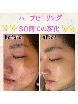 コハル(KOHARU)/月2回ご来店、1年半ご来店