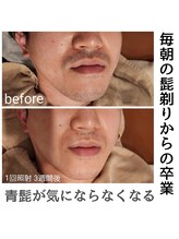 ルオント(LUONTO)/脱毛効果☆出力設定に秘密あり