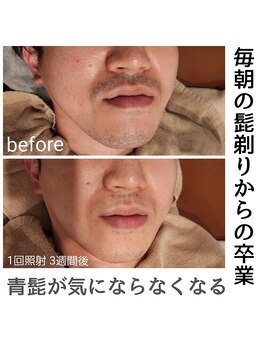 ルオント(LUONTO)/脱毛効果☆出力設定に秘密あり