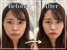 R-1ビューティーサロン 銀座/BEFORE＆AFTER　1回目