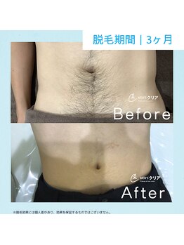 メンズクリア 渋谷明治通り店/【メンズクリア】お客様の施術例