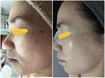 ルノン(LUNON)/ビフォーアフター集