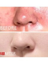 ビハダ(BeHADA)/#シツコイニキビケア#アクネケア