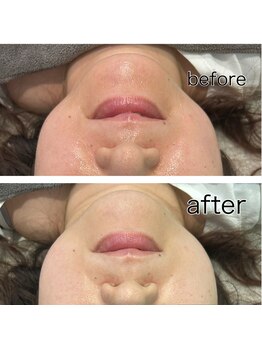 レイモード(Ray mode)/BBLフェイシャル