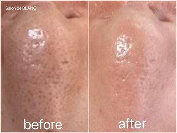 サロン ド ブラン アオヤマ(Salon de BLANC AOYAMA)/クリスティーナハーブピーリング