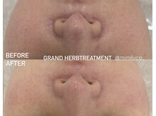 ミミルーチェ(mimiluce)/通常ハーブ2倍効果グランハーブ