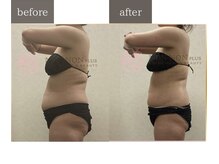 ノンノンプラス 博多(NON-NONプラス)/痩身結果