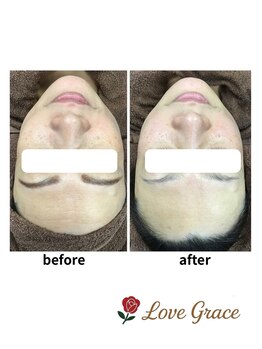 ラブグレイス(Lovegrace)/フェイシャル